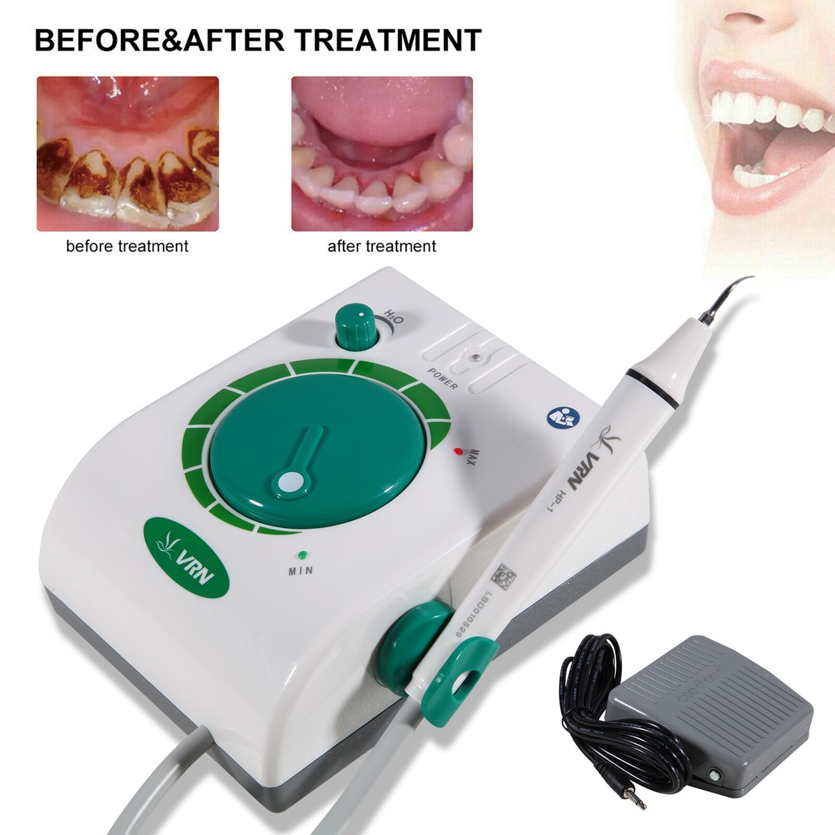 Ultrasonic Dental Scaler